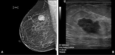 TTF-1 Positive Primary Small Cell Carcinoma of the Breast: A Case Report and Review of the Literature